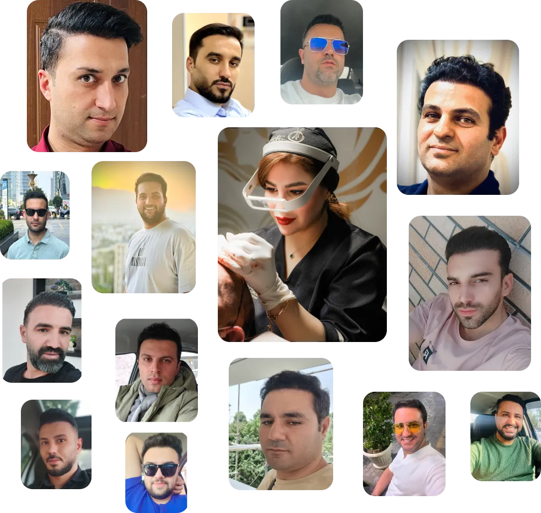 نمونه کار کاشت مو